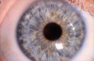 Closeup of Corneal Crosslinking