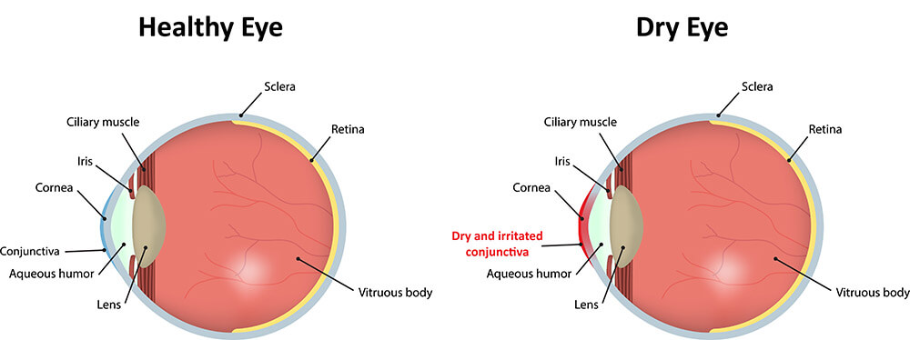 Chart Illustrating a Healthy Eye Compared to One Experiencing Dry Eye