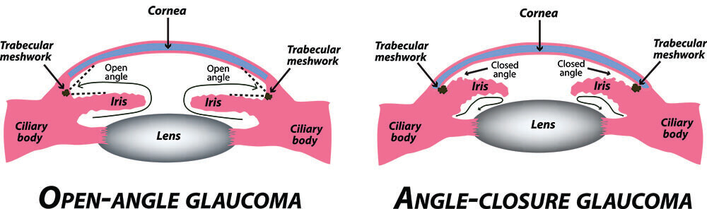 Chart Illustrating Open-Angle Glaucoma and Angle-Closure Glaucoma