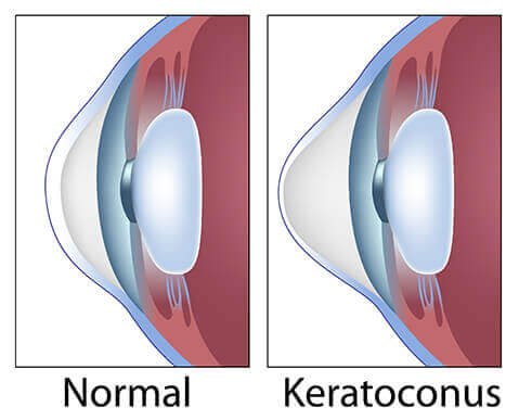 Chart Illustrating a Normal Eye vs One With Keratoconus