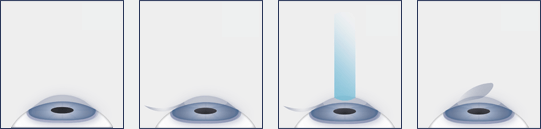 Chart Illustrating the LASIK Surgery Process