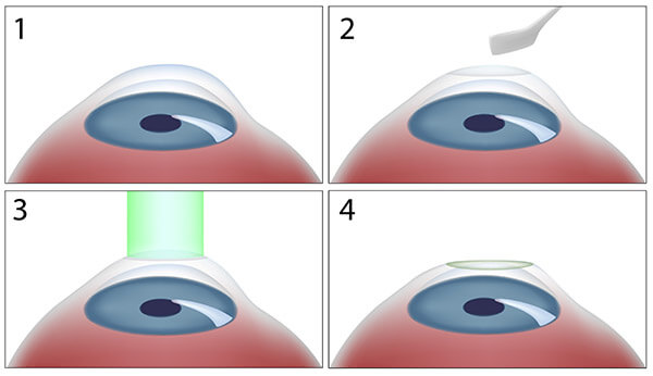 Chart Illustrating the PRK Surgery Process